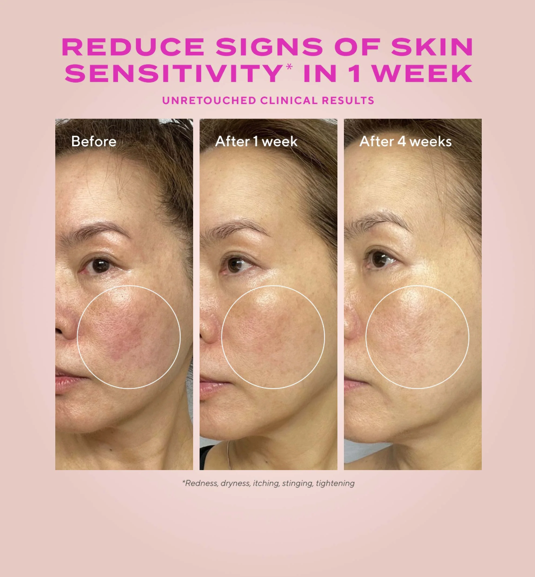 Before and after skin sensitivity reduction treatment showing a woman's face with visible redness over time.