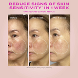 Before and after skin sensitivity reduction treatment showing a woman's face with visible redness over time.