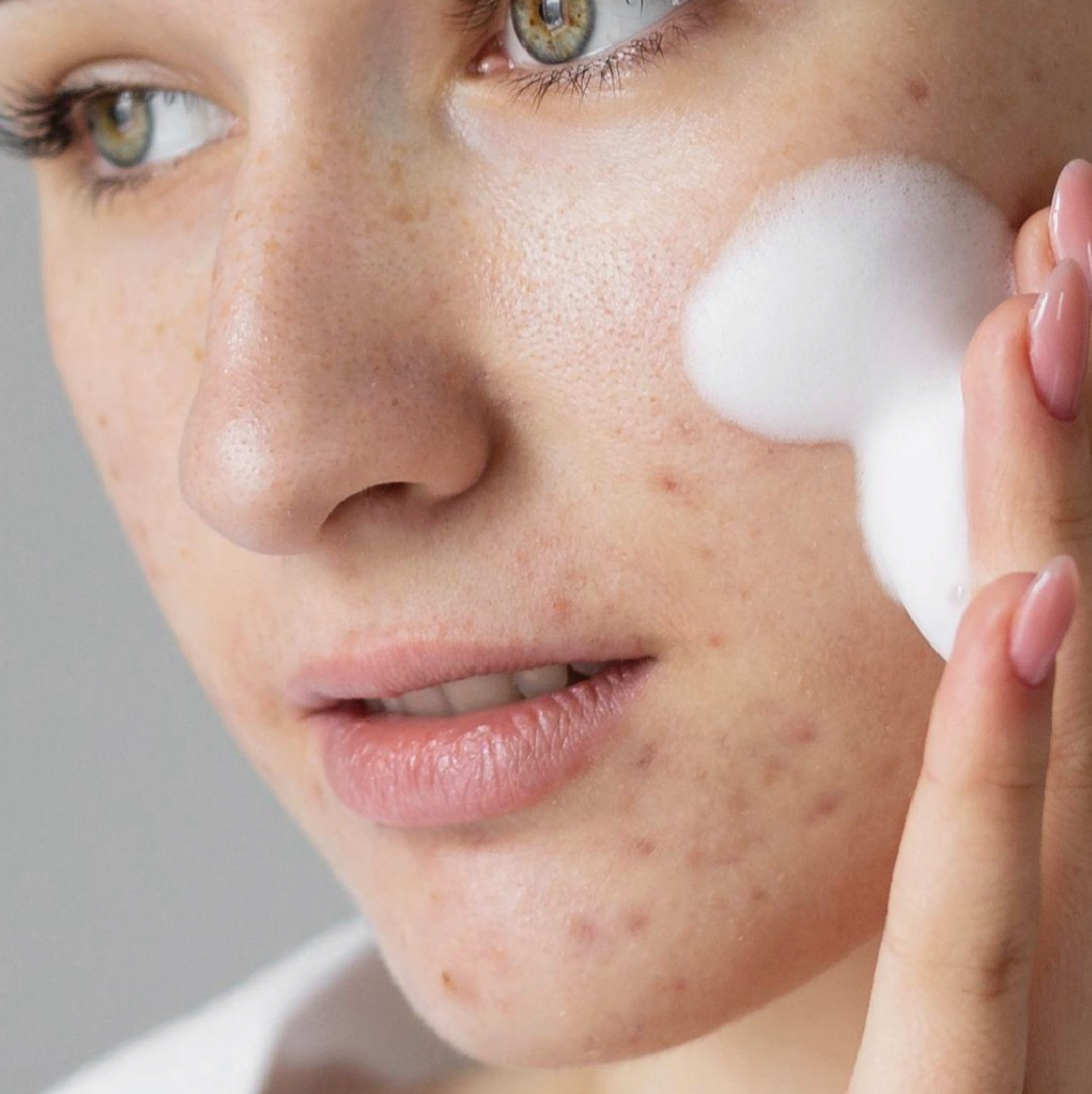 up close of womans face with a breakout and cleanser being rubbed in