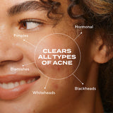 Biome-Balancing Clear & Prevent Blemish Treatment Serum